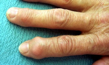 Artrosis en los dedos de la mano
