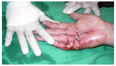 Cirugía del dupuytren en la Etapa IV 