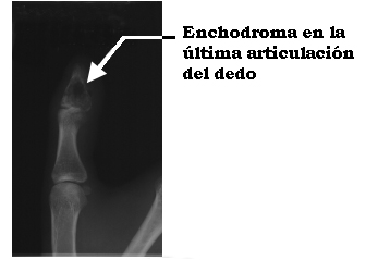 Enchodroma en la ultima articulación del dedo