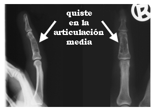 Quiste en la articulación media