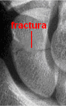 Fractura del hueso escafoides