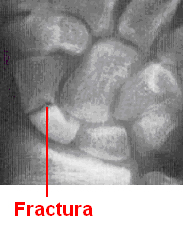 Pseudoatrosis en una fractura