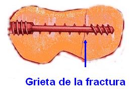 Tornillo de Herbert 