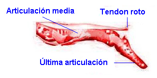 Lesión en el tendón