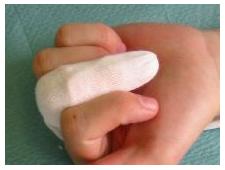 Postura correcta de un entablillado en el dedo