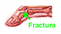 Fractura en el dedo