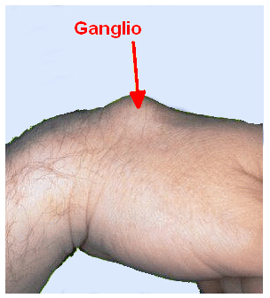 Ganglio común en la muñeca