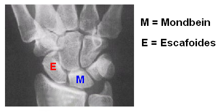Mondbein  a el escafoides