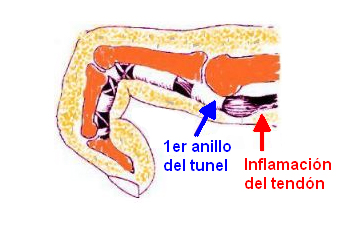 Comportamiento del tendón cuando el paciente lo flexiona