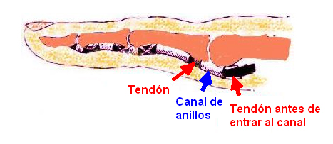 Comportamiento del tendón cuando el paciente estira el dedo