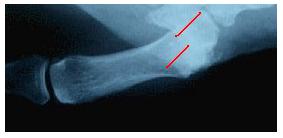 Radiografía de un pulgar inestable