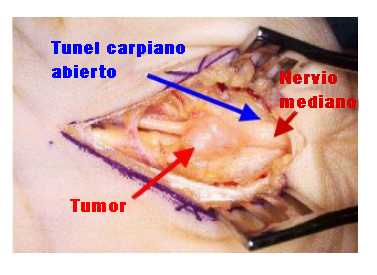 Tunel carpiano abierto